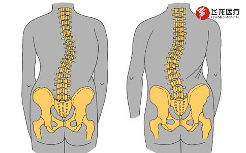 脊柱側(cè)彎