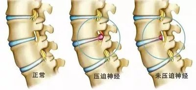 椎間盤病變對比